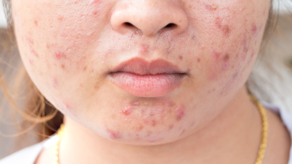 Hudproblem ger dåligt självförtroende